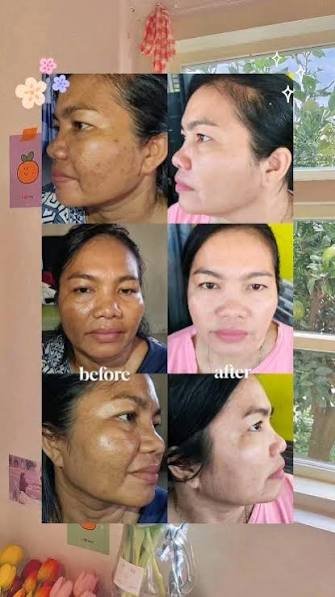 Kondisi kulit pengguna setelah menggunakan rangkaian Amorannisa Skincare